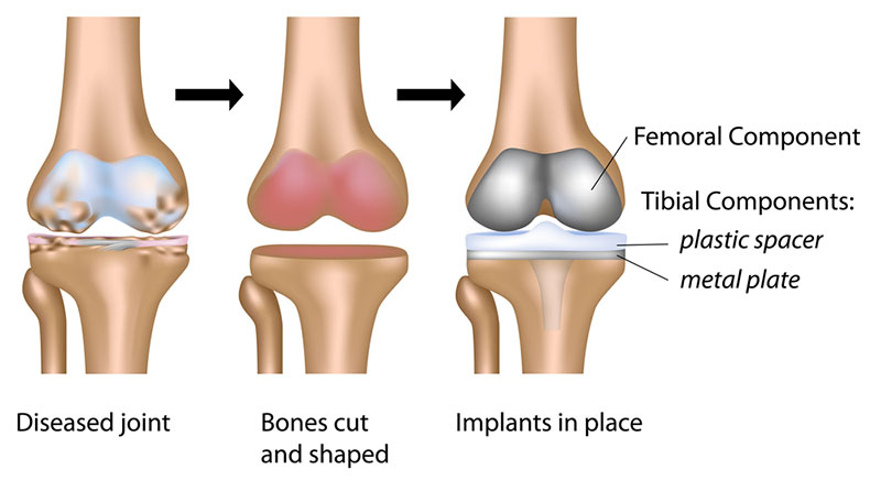 ACL and PCL ligaments of the knee